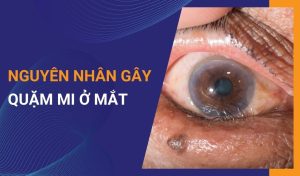 Tại sao bạn bị quặm mi ở mắt