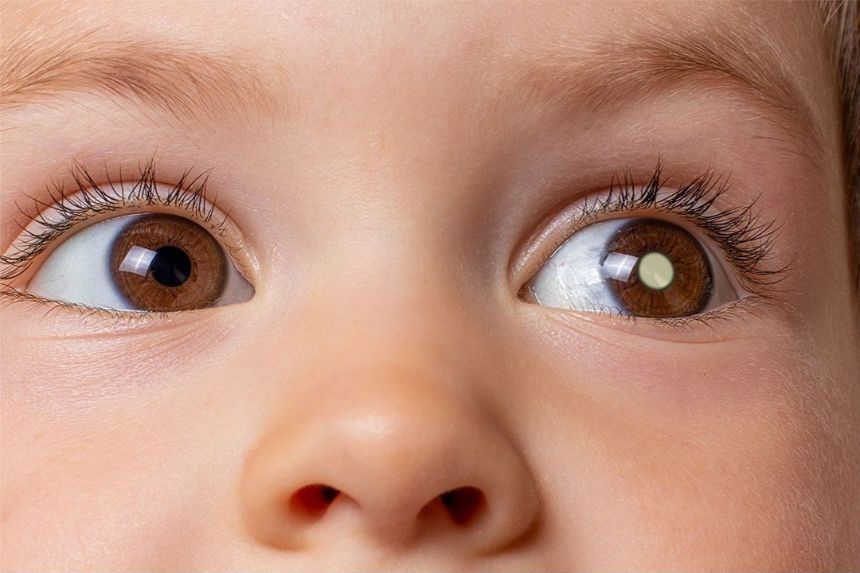 U nguyên bào võng mạc phổ biến nhất ở trẻ em